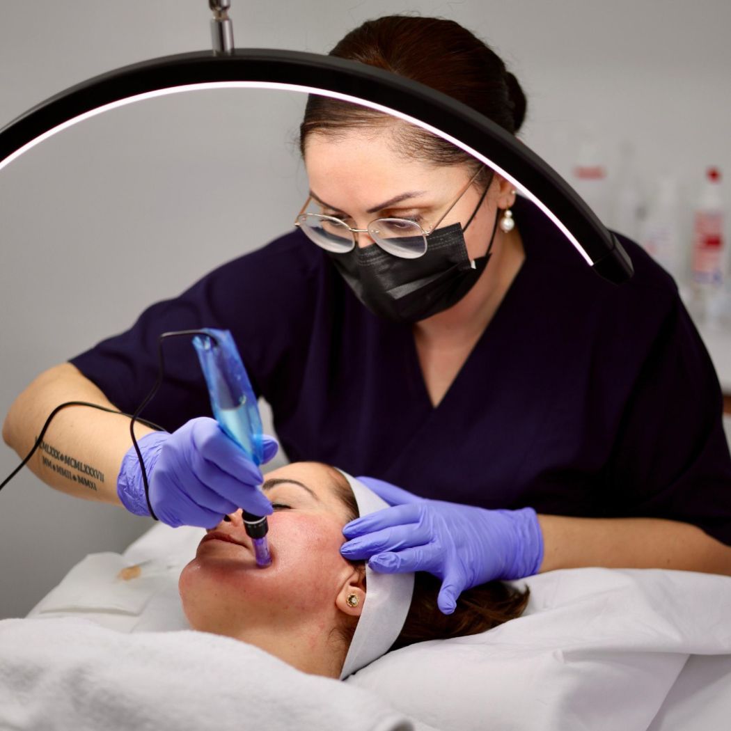 Microneedling Sursee Needling