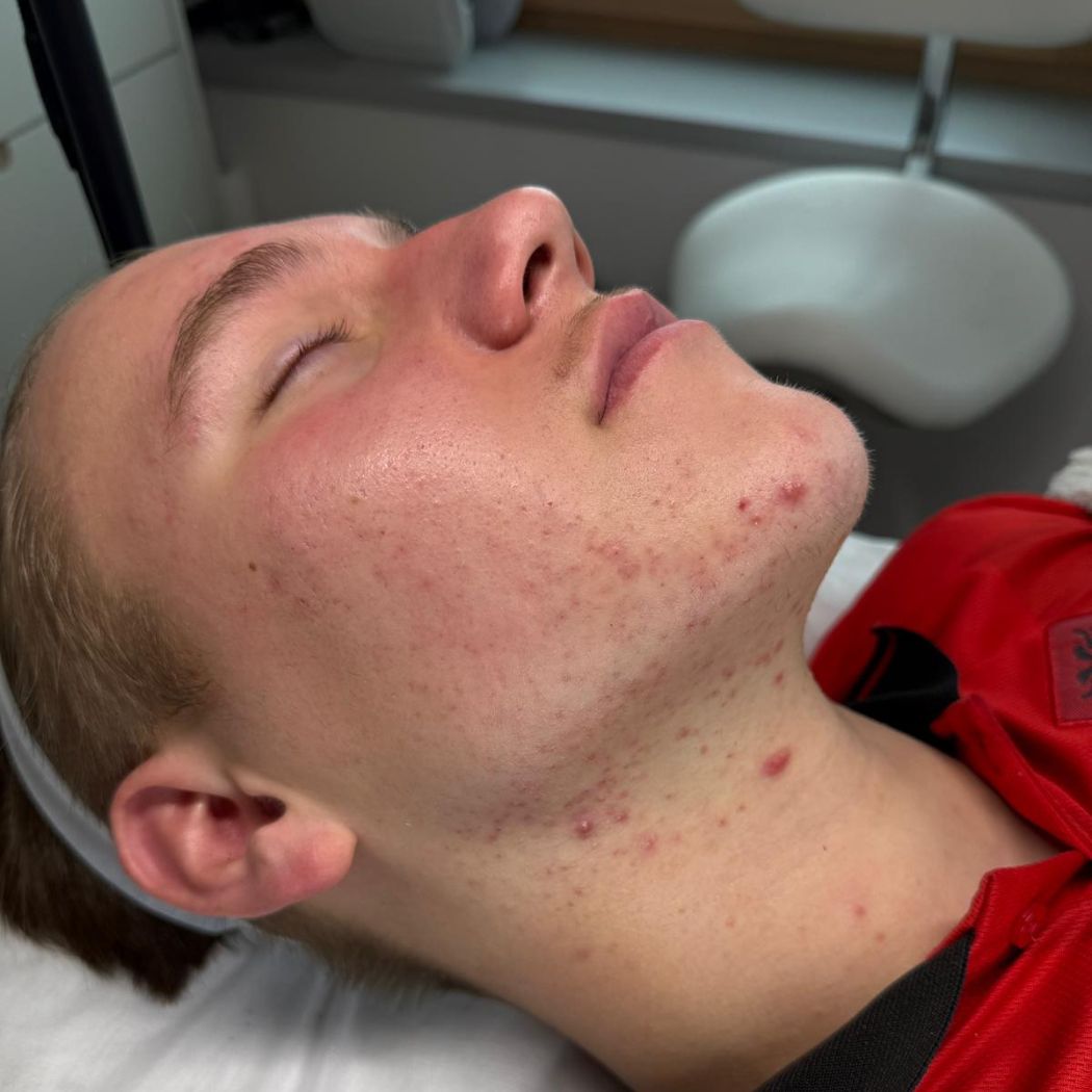 Acne / Rosacea Sursee